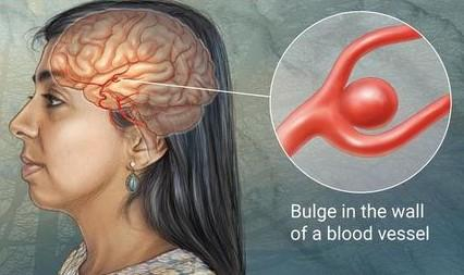 Brain Aneurysm on the rise in Ghana – Radiologist reveals Brain Aneurysm on the rise in Ghana – Radiologist reveals